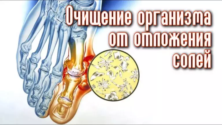 Выводим отложения солей из суставов навсегда