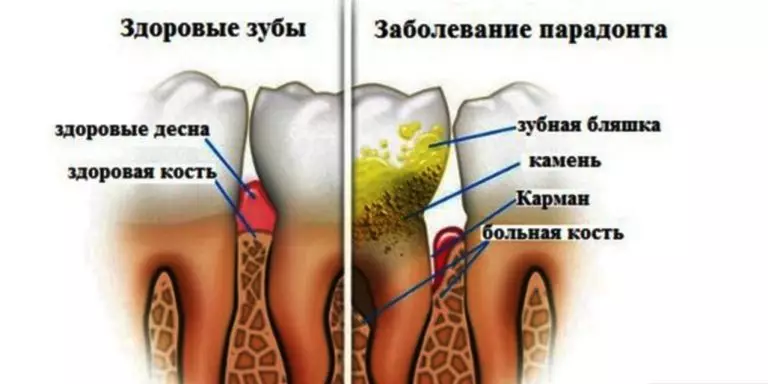 Избавься от зубного камня. Поможет 1 простое средство