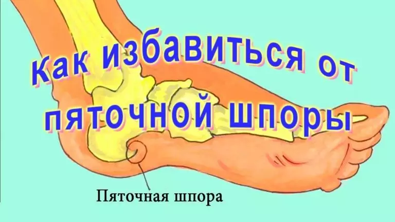 Проверенный рецепт. Избавляемся от пяточной шпоры