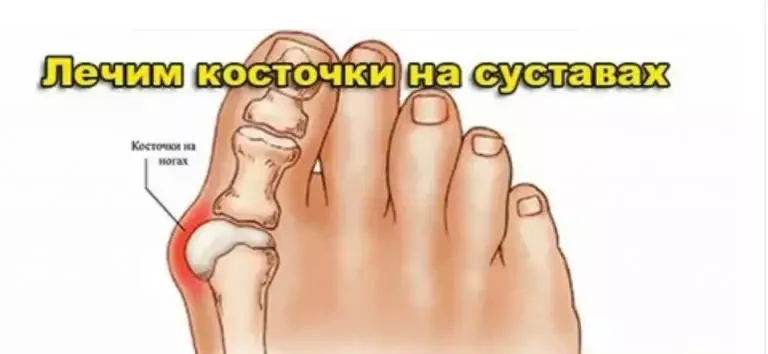 ЛЕЧИМ КОСТОЧКИ НА СУСТАВАХ
