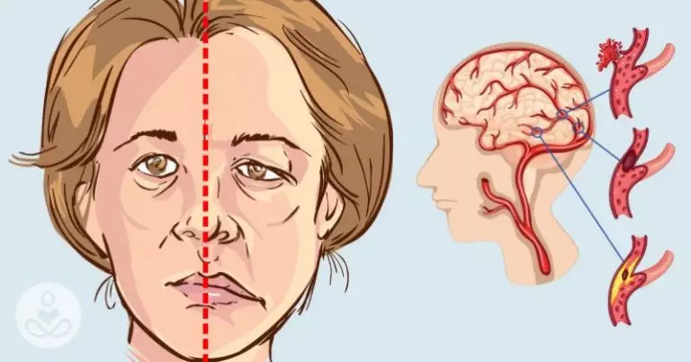 4 признака, что у человека сегодня может случиться инсульт