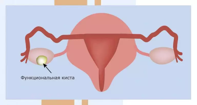 Как избавиться от заболеваний яичников и матки всего за месяц. Рецепты наших бабушек